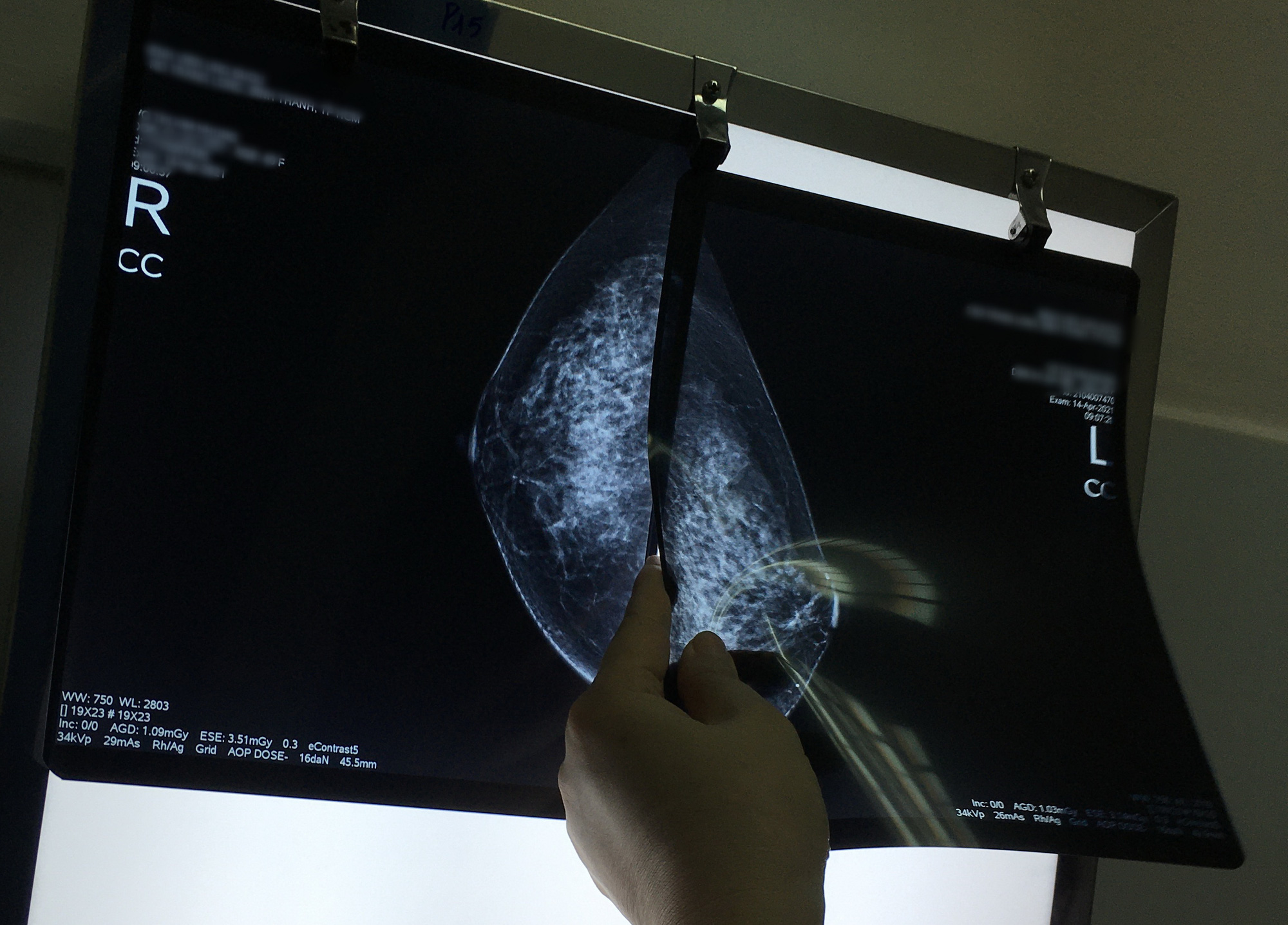 Bác sĩ đọc kết quả chụp nhũ ảnh của một bệnh nhân - Ảnh: MINH ANH Bác sĩ đọc kết quả chụp nhũ ảnh của một bệnh nhân - Ảnh: MINH ANH