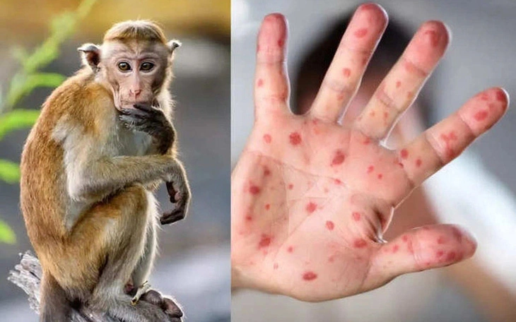 Các ban đỏ nổi trên tay một bệnh nhân mắc đậu mùa khỉ - Ảnh: who.int