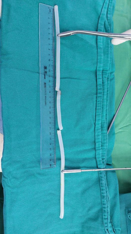 Đoạn keo nến dài 40m được người đàn ông nhét vào niệu đạo Đoạn keo nến dài 40m được người đàn ông nhét vào niệu đạo