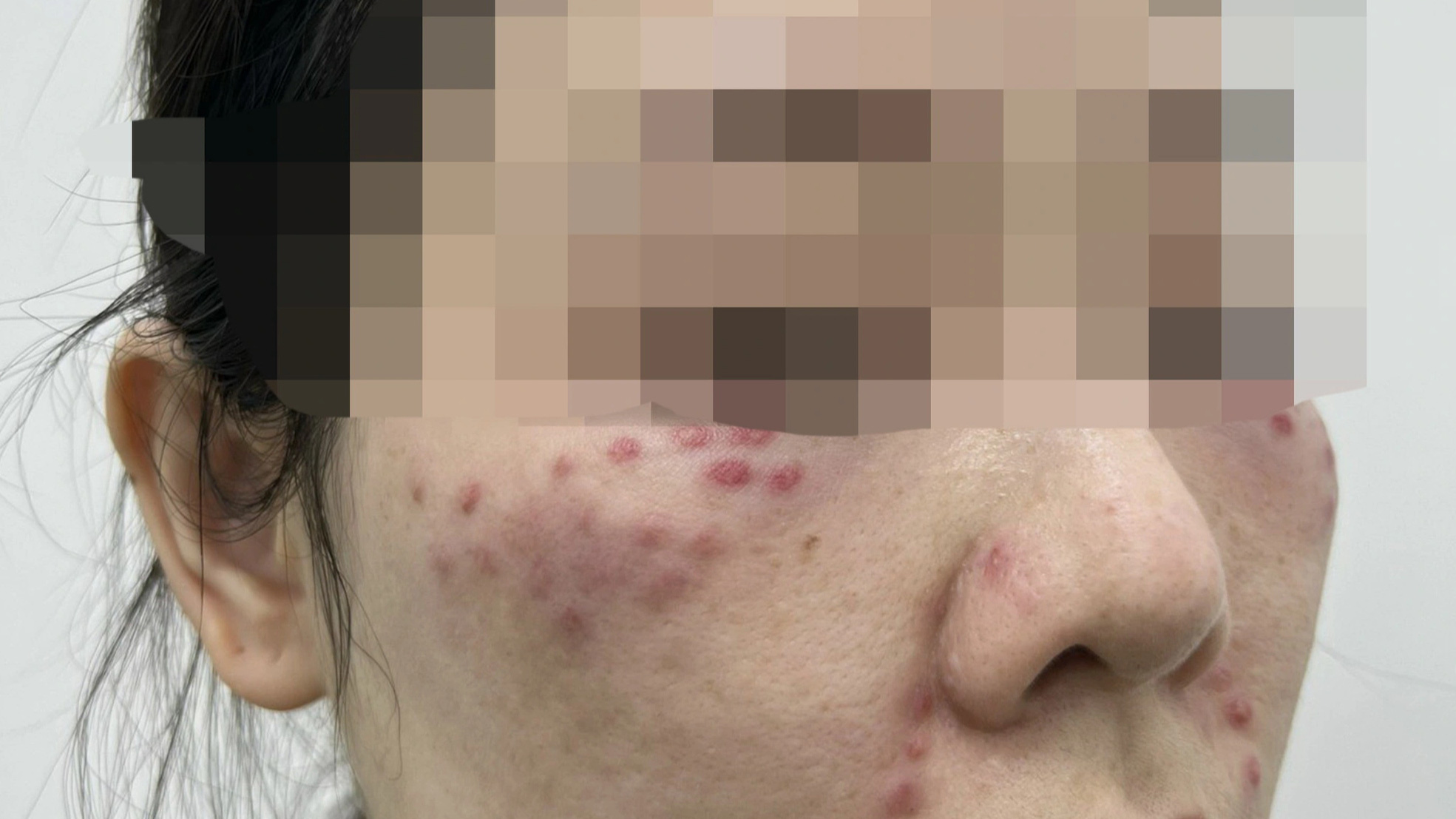 Khuôn mặt của một người phụ nữ chi chít nốt tiêm sưng nề, đỏ đau sau tiêm “tế bào gốc” - Ảnh: BVCC