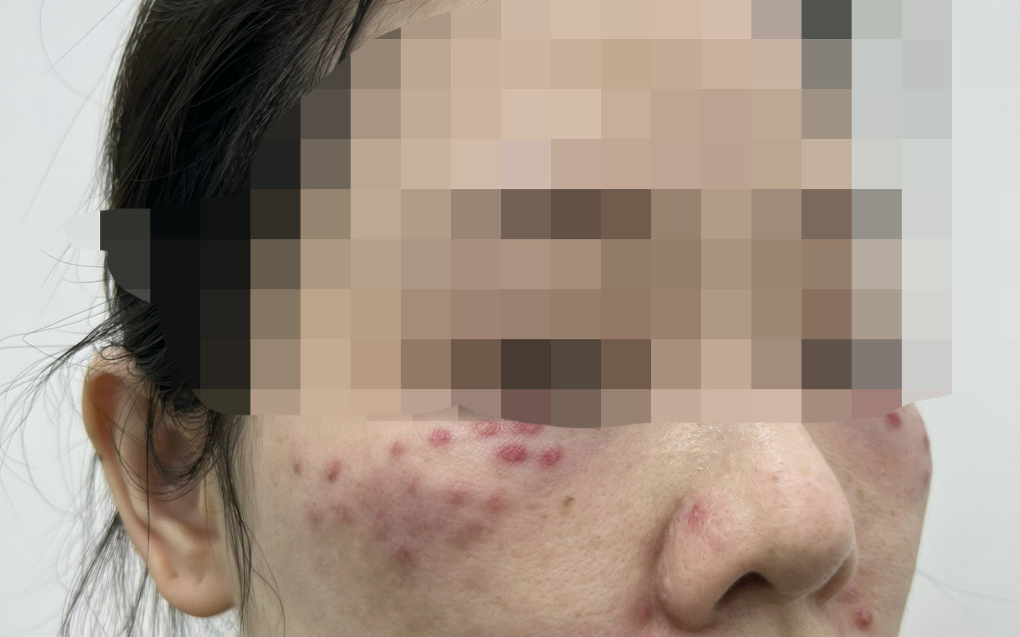 Tế bào gốc làm đẹp: Có phải thần dược để