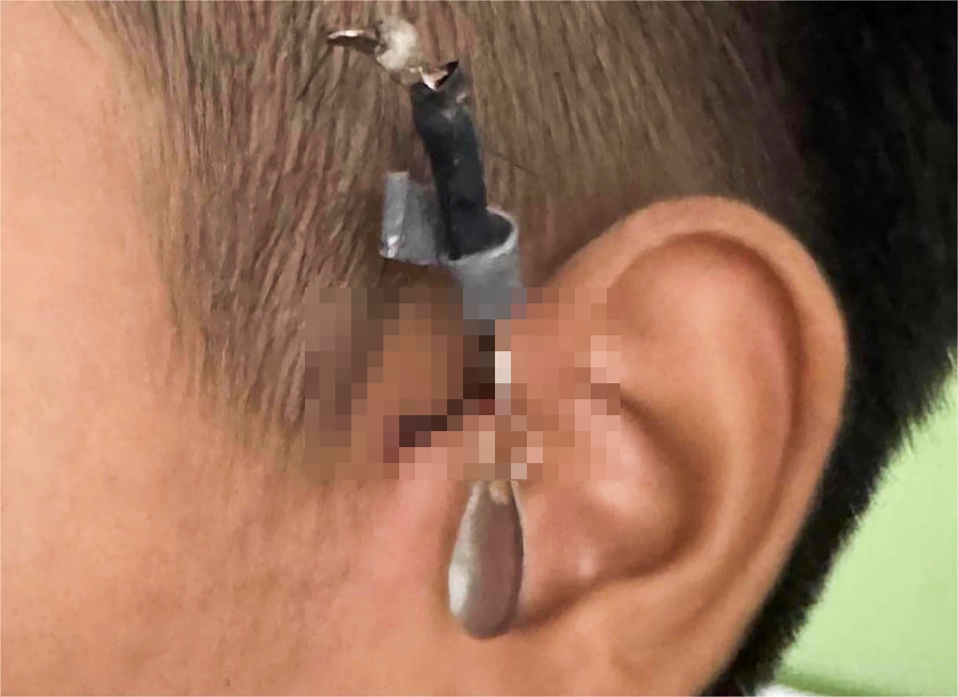 Xem câu cá, bé trai bị móc câu đâm sâu vào tai - Ảnh 1.