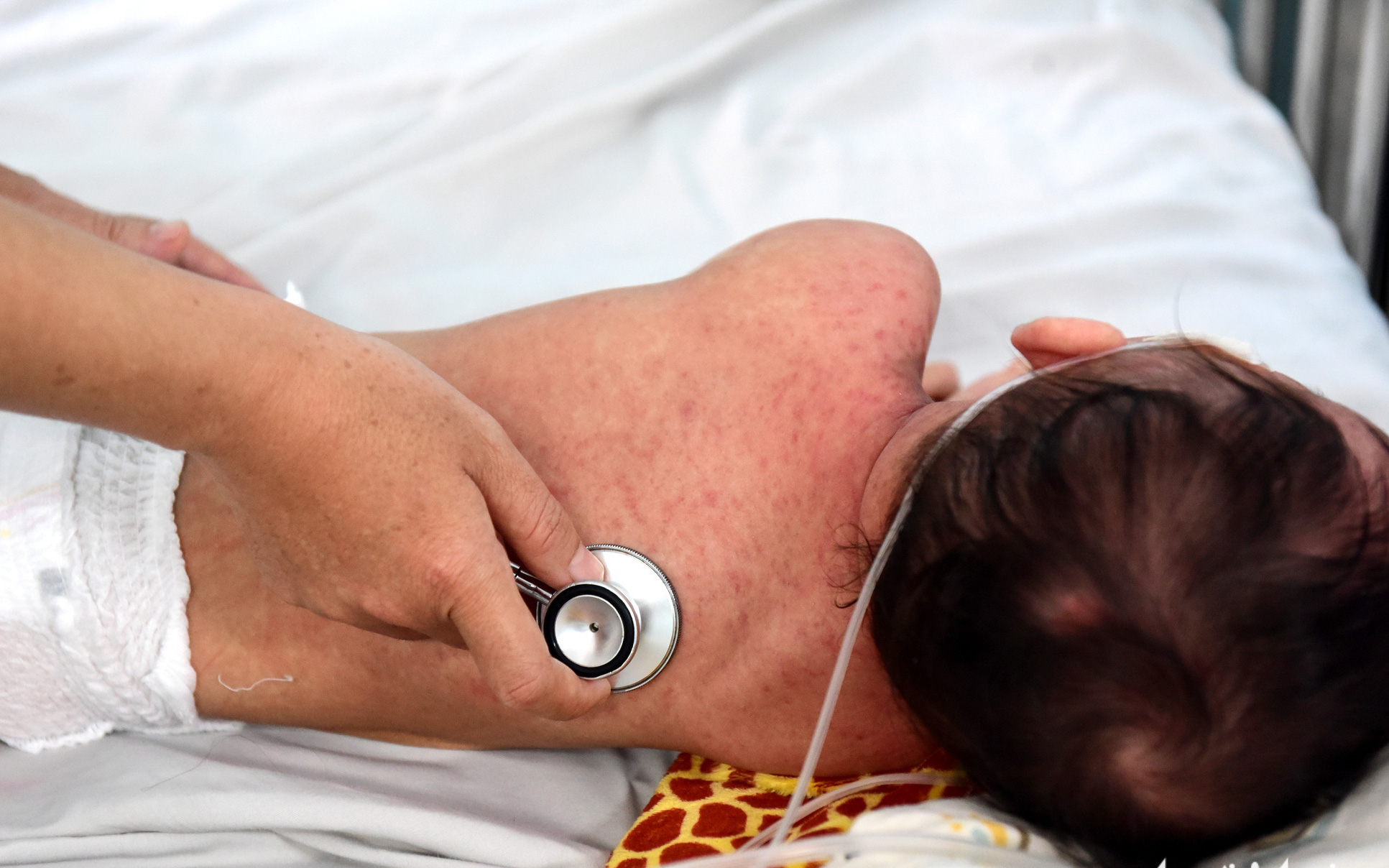 Bệnh sởi vẫn chưa hạ nhiệt, Cần Thơ tiếp tục tiêm vaccine - Ảnh 3.