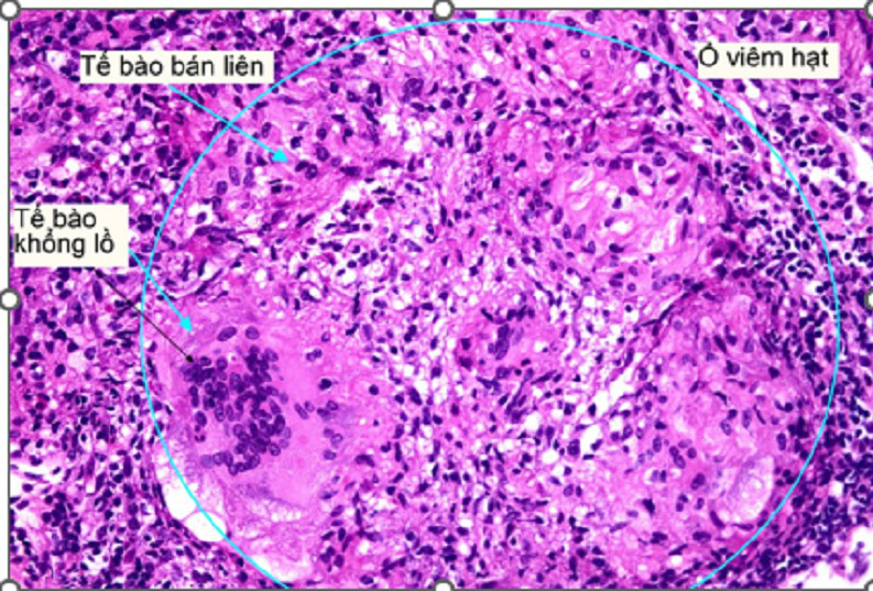 Hình ảnh kết quả giải phẫu bệnh có ổ viêm hạt hướng đến lao - Ảnh: BVCC