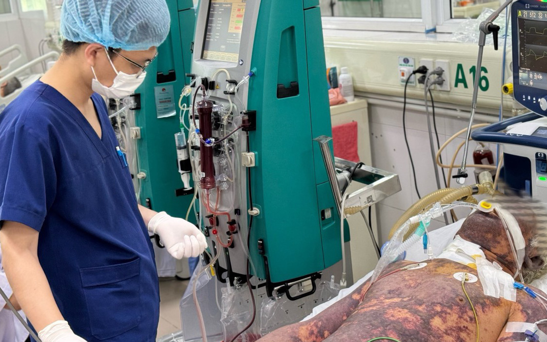 Mua thủ lợn sống về làm món ăn, bị nhiễm khuẩn huyết nguy kịch- Ảnh 2. Không ăn thịt chua, tiết canh, người đàn ông vẫn nguy kịch vì nhiễm liên cầu lợn