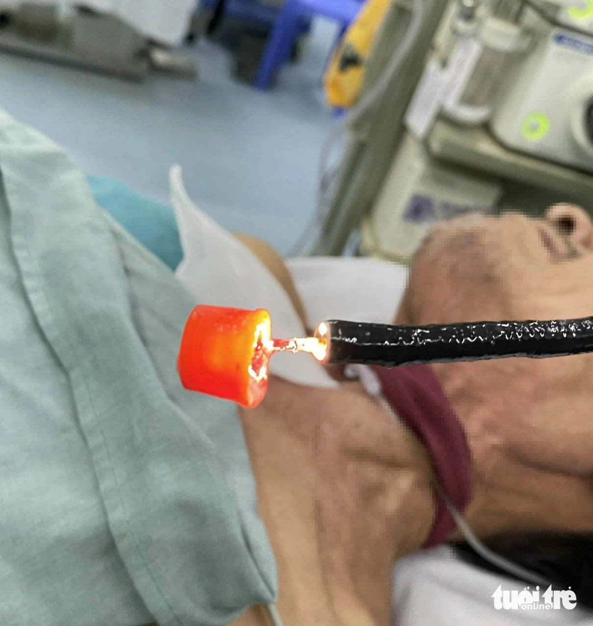 Lấy nắp chai dầu trong cổ cụ ông 74 tuổi- Ảnh 1. Các bác sĩ của Bệnh viện Đa khoa khu vực tỉnh An Giang đã lấy nắp chai dầu rơi trong cổ bệnh nhân - Ảnh: Bệnh viện cung cấp