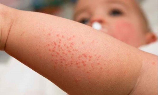 TP.HCM: 60 ca sốt phát ban trong tuần, nghi bệnh sởi- Ảnh 1. Trẻ em mắc bệnh sởi - Ảnh tư liệu