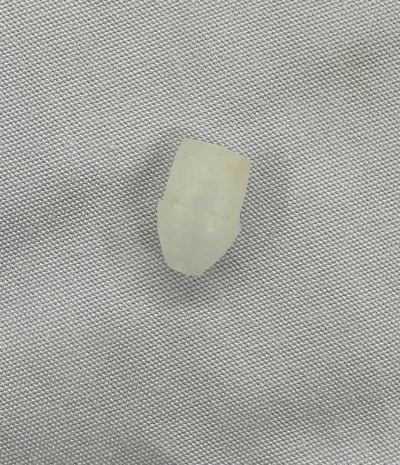 Bé trai đang cười thì bị đầu bút bi quăng vào miệng, lọt xuống đường thở- Ảnh 1. Đầu bút bi được gắp ra - Ảnh: Bệnh viện cung cấp