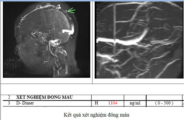 Đau đầu 4 ngày, đến viện mới phát hiện mắc thể đột quỵ não đặc biệt - Ảnh 1. Đau đầu 4 ngày, đến viện mới phát hiện mắc thể đột quỵ não đặc biệt - Ảnh 1.