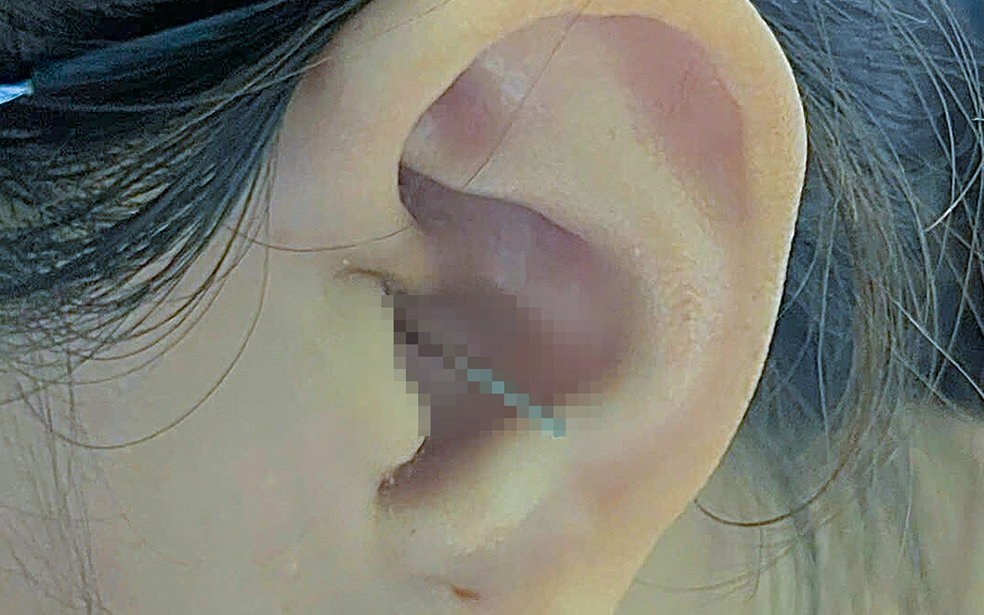 Chồng bất ngờ ôm vợ trong lúc vợ đang ngoáy tai làm dị vật đâm sâu vào tai trái - Ảnh 1. Chồng bất ngờ ôm vợ trong lúc vợ đang ngoáy tai làm dị vật đâm sâu vào tai trái - Ảnh 2.