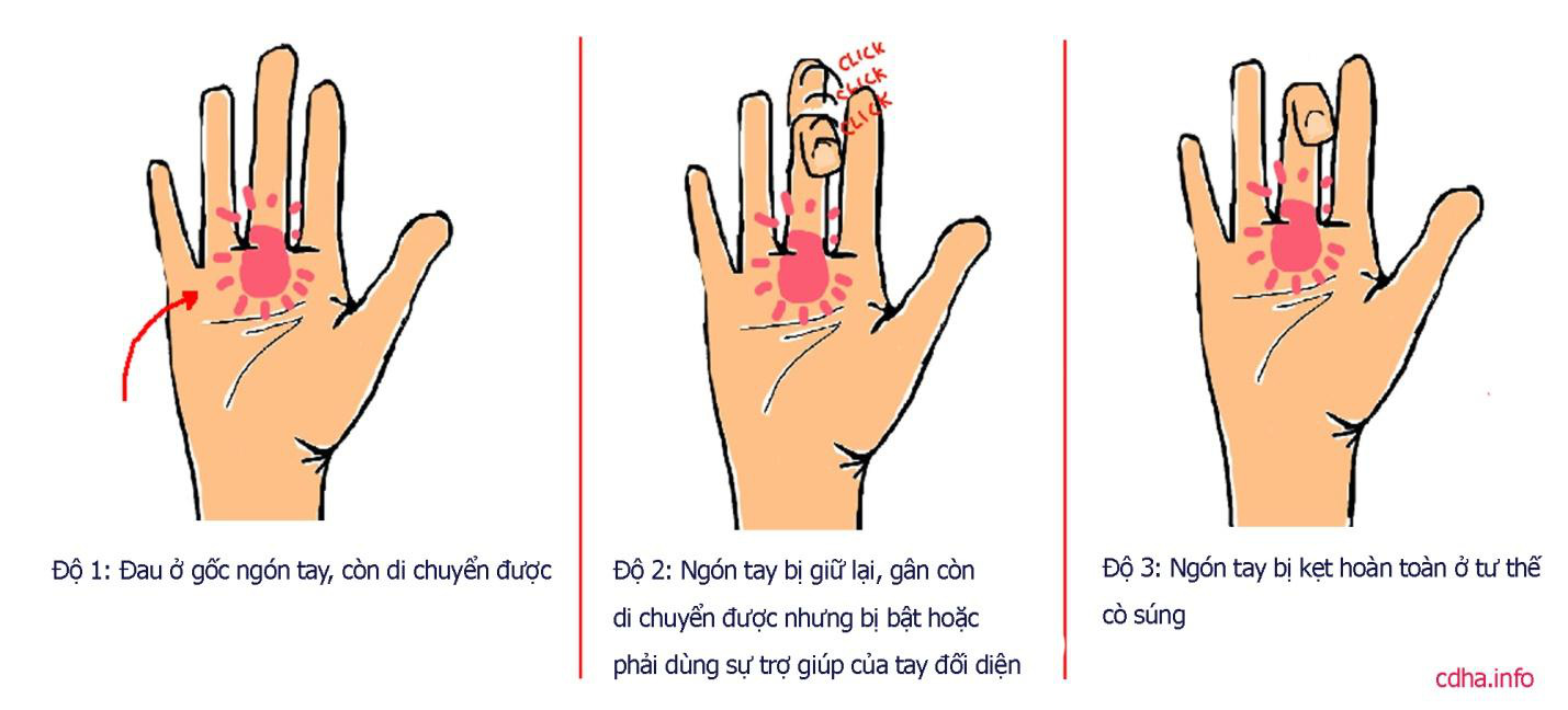 Ngón tay gấp khó duỗi, có nguy hiểm không? - Ảnh 1. Ngón tay gấp khó duỗi, có nguy hiểm không? - Ảnh 1.