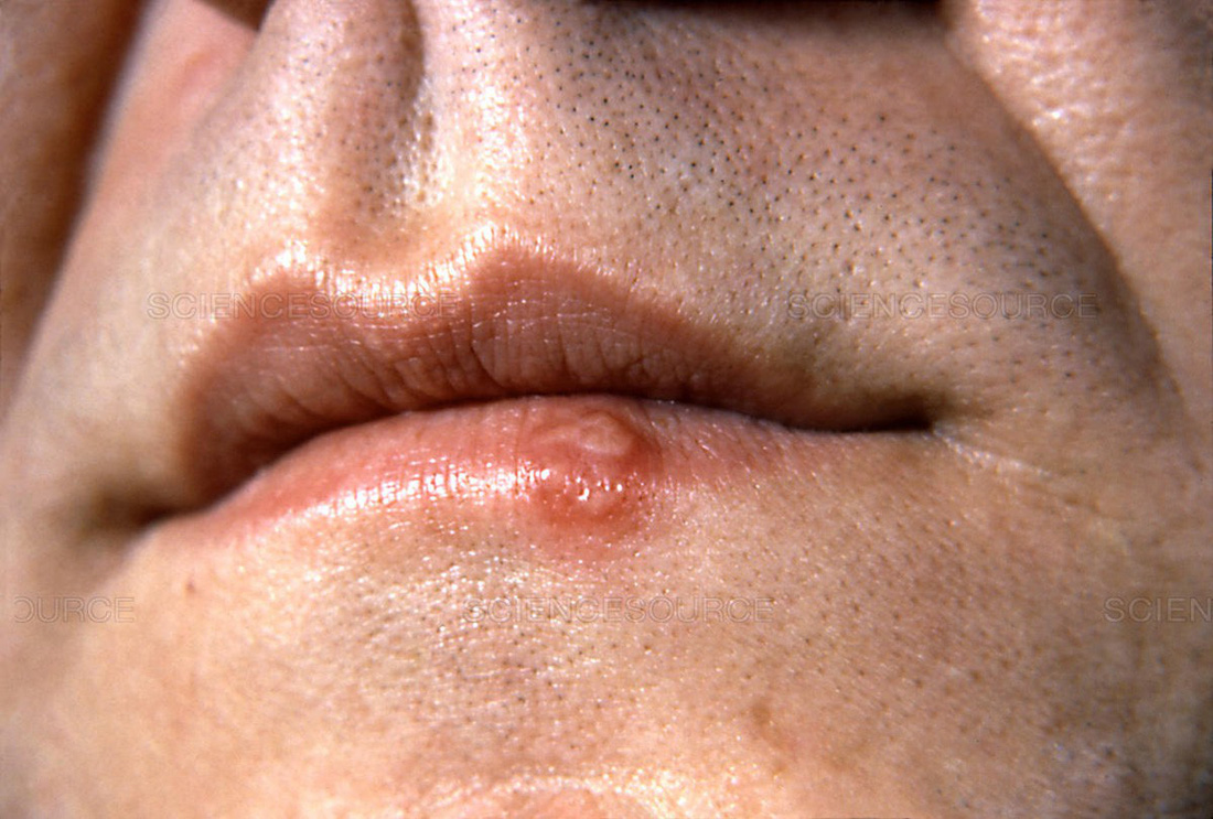 Herpes môi (mụn rộp môi) - Ảnh 1.