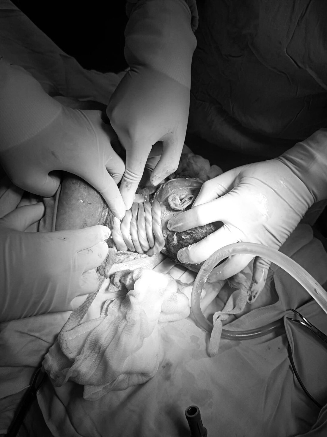 Cháu bé bị dây rốn quấn 6 vòng quanh cổ ra đời an toàn tại Bệnh viện Phụ sản - Nhi Đà Nẵng - Ảnh: QUỲNH MAI