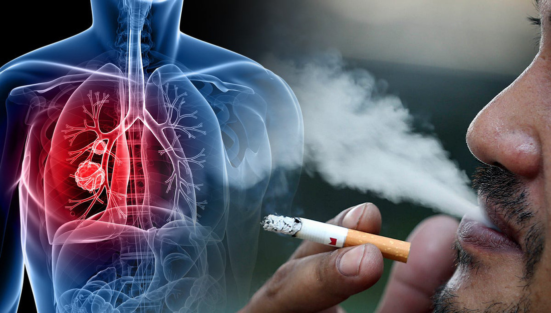 Hút thuốc là yếu tố nguy cơ hàng đầu với bệnh ung thư phổi