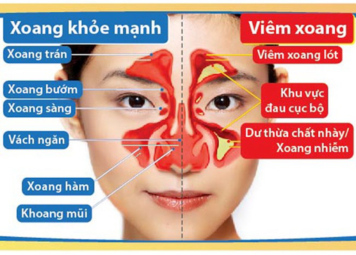Kết quả hình ảnh cho viêm xoang