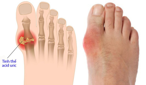 Cách phòng chống bệnh gout - Tuổi Trẻ Online