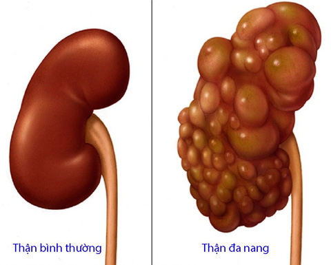 Đa Nang Thận: Tìm Hiểu Nguyên Nhân, Triệu Chứng Và Giải Pháp Điều Trị Hiệu Quả