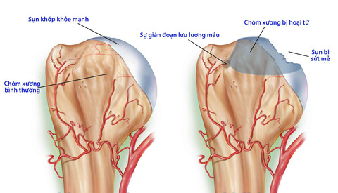 7. Tiến triển và biến chứng