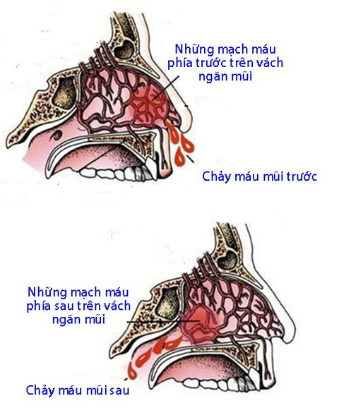 Chảy Máu Mũi Sau - Nguyên Nhân, Triệu Chứng và Cách Điều Trị Hiệu Quả