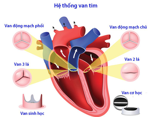 4. Biến chứng của bệnh van tim