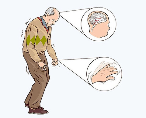 Bệnh Parkinson, người cao tuổi nên biết - Tuổi Trẻ Online