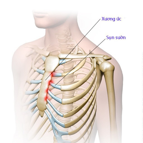 Sưng Xương Ức: Nguyên Nhân, Triệu Chứng và Cách Điều Trị Hiệu Quả