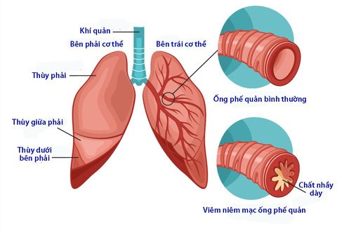 Phế quản phế viêm là gì? Nguyên nhân, triệu chứng và cách điều trị hiệu quả