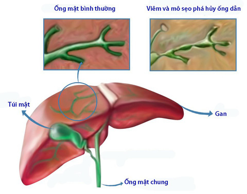 Xơ Gan Mật Nguyên Phát: Nguyên Nhân, Triệu Chứng và Giải Pháp Điều Trị Hiệu Quả