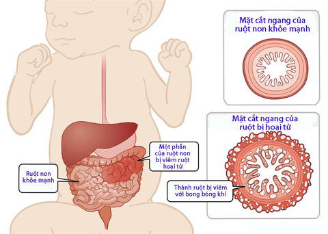 3. Ảnh hưởng của việc cắt ruột non đến sức khỏe