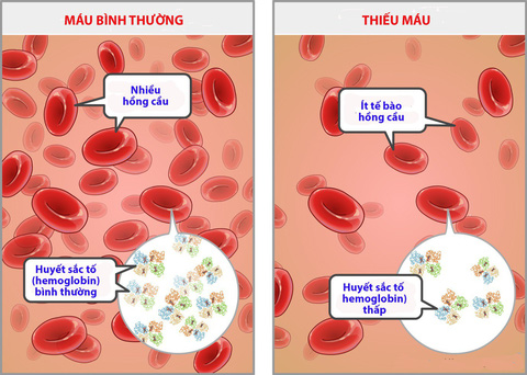 Bệnh Thiếu Máu ở Trẻ Sơ Sinh: Nguyên Nhân, Triệu Chứng và Cách Điều Trị Hiệu Quả