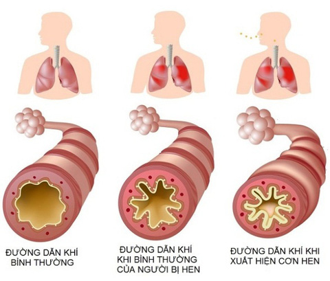 1. Nguyên nhân ho khó thở có đờm