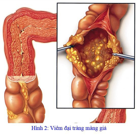 Các nghiên cứu và tiến bộ mới trong điều trị Viêm Đại Tràng Màng Giả