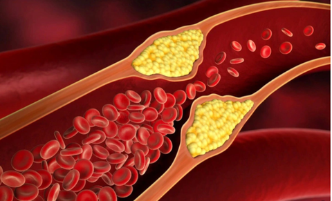 Mỡ Máu Cao: Nguyên Nhân, Triệu Chứng, Điều Trị và Phòng Ngừa Hiệu Quả