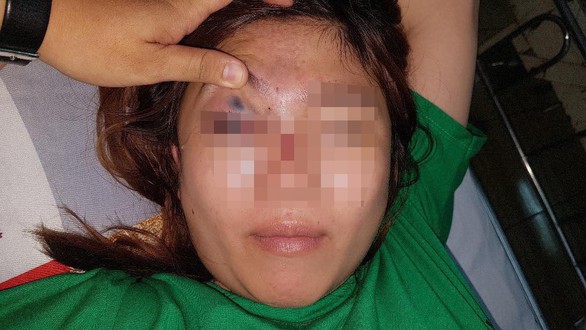 Mất thị lực do bạn trai tiêm chất làm đầy nâng mũi - Ảnh 1. Mất thị lực do bạn trai tiêm chất làm đầy nâng mũi - Ảnh 1.