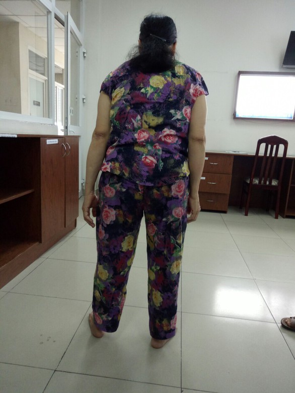 Thay hai khớp háng giúp người viêm cột sống dính khớp đi lại - Ảnh 4. Thay hai khớp háng giúp người viêm cột sống dính khớp đi lại - Ảnh 4.