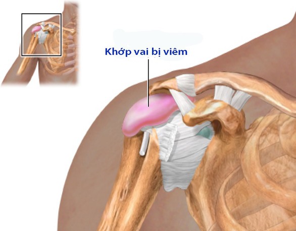 Viêm quanh khớp vai - Ảnh 1. Viêm quanh khớp vai - Ảnh 1.