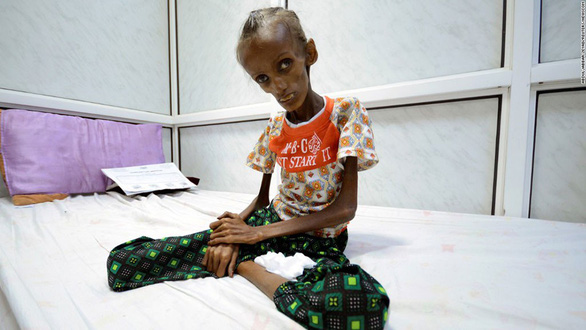 Ở Yemen, đến khóc cũng không còn nước mắt vì đói khát - Ảnh 2. Ở Yemen, đến khóc cũng không còn nước mắt vì đói khát - Ảnh 2.