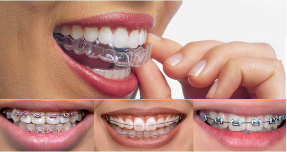 Phương pháp niềng răng phù hợp cho tuổi thanh, thiếu niên - Ảnh 3. Phương pháp niềng răng phù hợp cho tuổi thanh, thiếu niên - Ảnh 3.