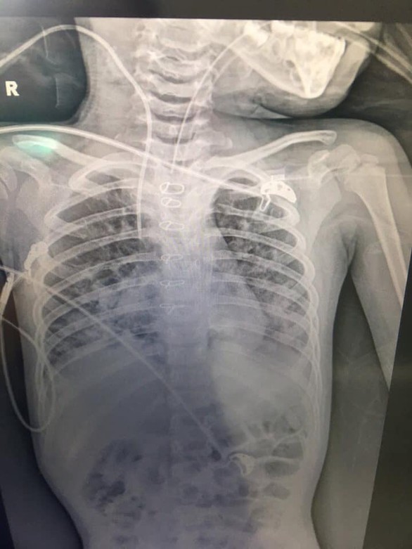 Phổi bé 3 tuổi trắng xóa vì uống nhầm dầu hỏa - Ảnh 1. Phổi bé 3 tuổi trắng xóa vì uống nhầm dầu hỏa - Ảnh 1.