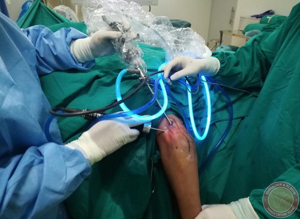 Gắp 200 hạt sụn trong khớp khuỷu của một thanh niên 18 tuổi - Ảnh 2. Gắp 200 hạt sụn trong khớp khuỷu của một thanh niên 18 tuổi - Ảnh 2.