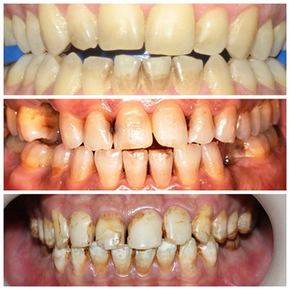 Bệnh viêm quanh răng do hút nhiều thuốc lá - Ảnh 1. Bệnh viêm quanh răng do hút nhiều thuốc lá - Ảnh 1.