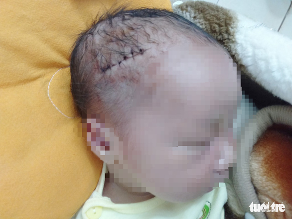 Bé trai sinh mổ bị dao cắt rách đầu, khâu 6 mũi - Ảnh 1. Bé trai sinh mổ bị dao cắt rách đầu, khâu 6 mũi - Ảnh 1.