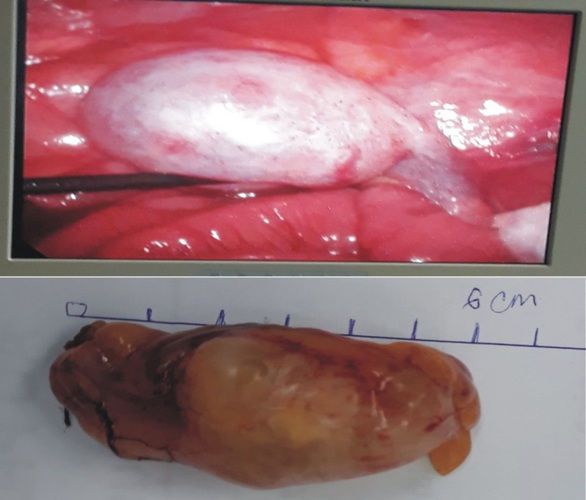 U nhầy ruột thừa bệnh lý khó lường - Ảnh 1. U nhầy ruột thừa bệnh lý khó lường - Ảnh 1.