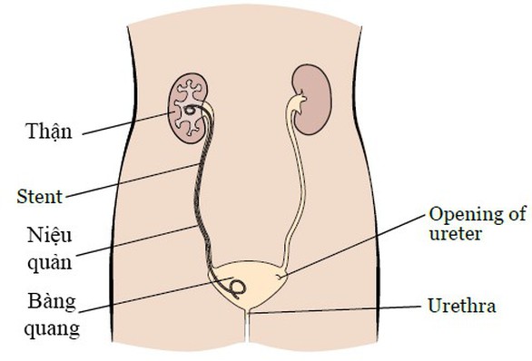 Nữ bệnh nhân quên tái khám rút stent nhựa trong thận và bàng quang - Ảnh 2. Nữ bệnh nhân quên tái khám rút stent nhựa trong thận và bàng quang - Ảnh 2.