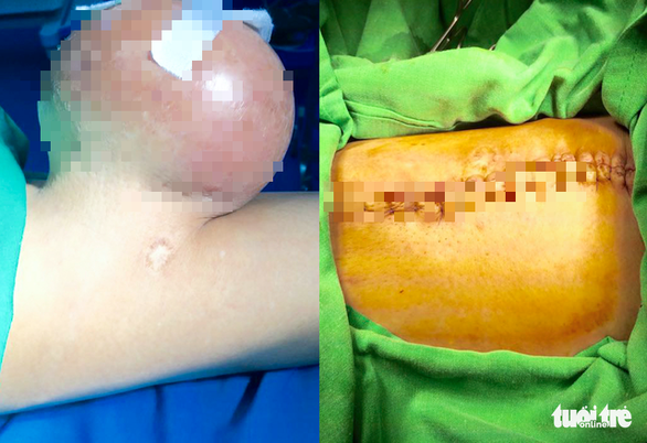 Cắt bỏ khối u 2 kí trên đùi người đàn ông suốt 12 năm - Ảnh 1. Cắt bỏ khối u 2 kí trên đùi người đàn ông suốt 12 năm - Ảnh 1.
