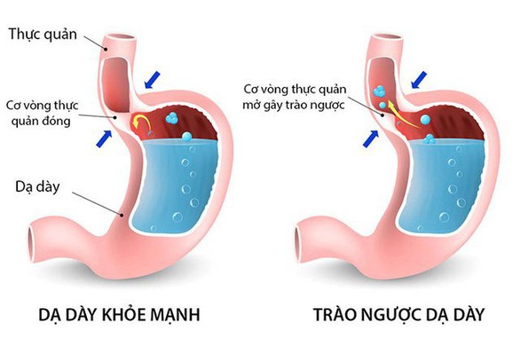 Trào ngược dạ dày thực quản ở trẻ em có phải ‘bệnh’? - Ảnh 1. Trào ngược dạ dày thực quản ở trẻ em có phải ‘bệnh’? - Ảnh 1.