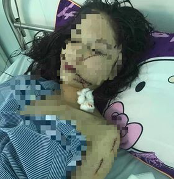 Cô gái 18 tuổi bị bạn rạch mặt, cổ, tay phải khâu 60 mũi - Ảnh 1. Cô gái 18 tuổi bị bạn rạch mặt, cổ, tay phải khâu 60 mũi - Ảnh 1.