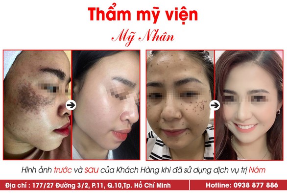 Sạch nám không tái phát nhờ điều trị theo phác đồ y học - Ảnh 1. Sạch nám không tái phát nhờ điều trị theo phác đồ y học - Ảnh 1.