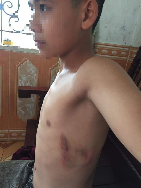 Phụ huynh hung hãn xông vào trường đánh học sinh lớp 7 thâm tím người - Ảnh 1. Phụ huynh hung hãn xông vào trường đánh học sinh lớp 7 thâm tím người - Ảnh 1.