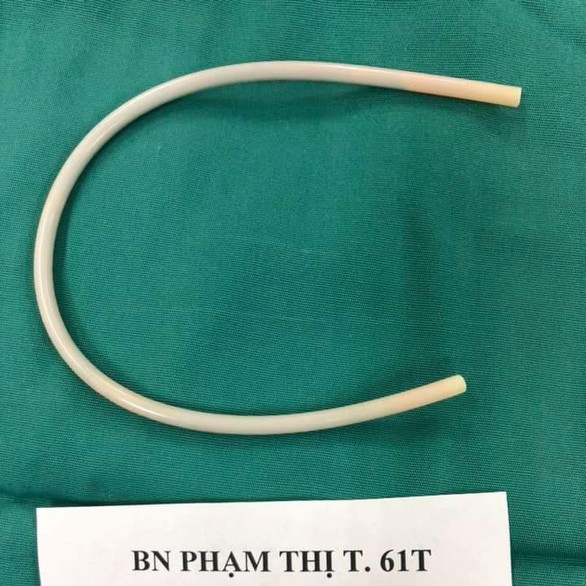 Clip lấy ống nhựa cứng dài 30cm trong khung chậu nữ bệnh nhân - Ảnh 1. Clip lấy ống nhựa cứng dài 30cm trong khung chậu nữ bệnh nhân - Ảnh 1.